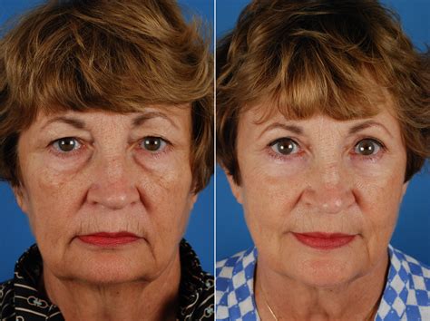 Score 4. . Who is the best blepharoplasty surgeon